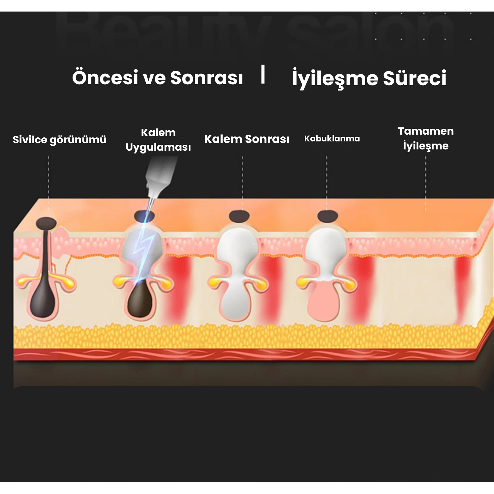 Sivilce Kaldırma Kalemi