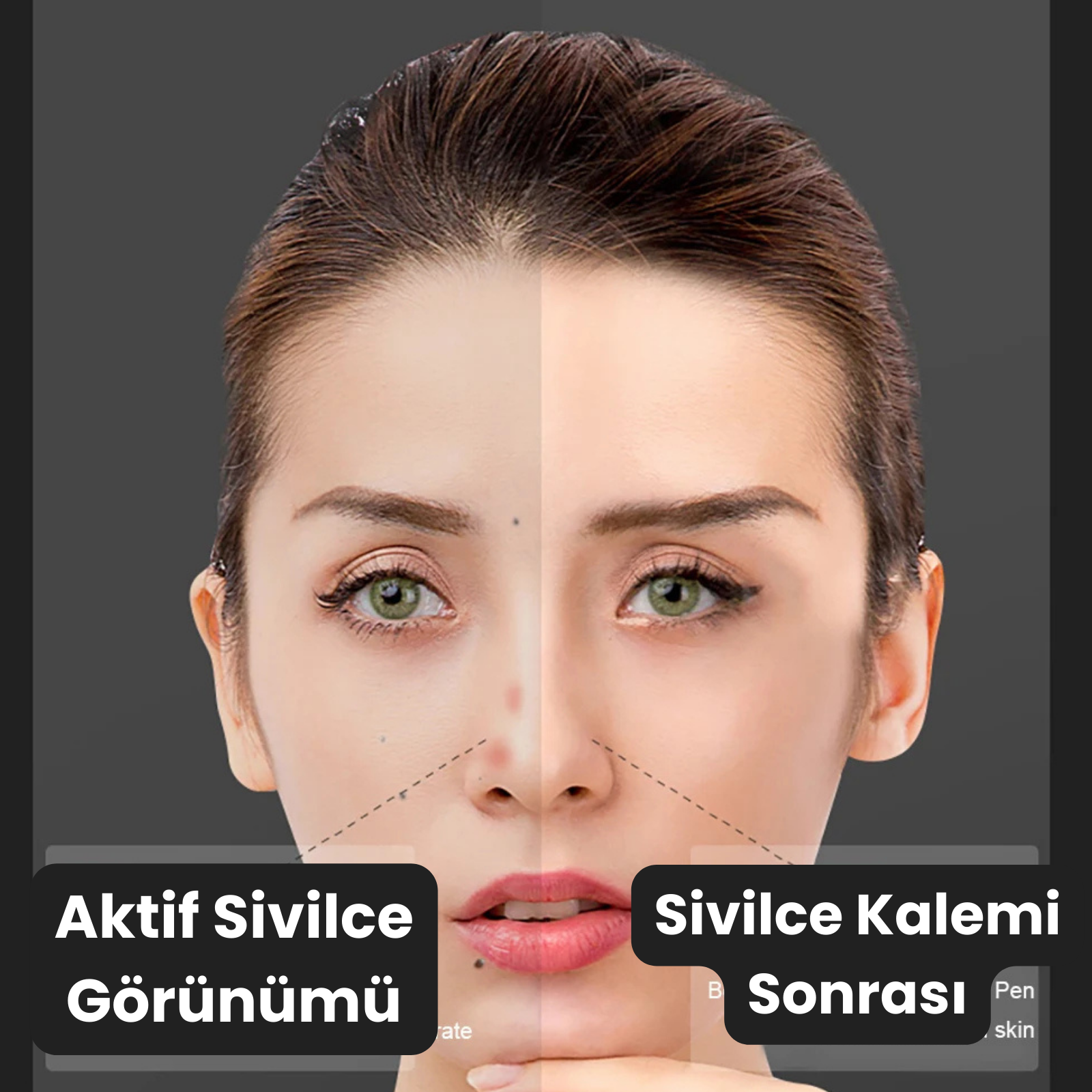 Sivilce Kaldırma Kalemi